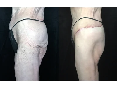 Before and after lower body lift, patient case 20024, view 3