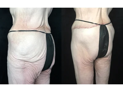 Before and after lower body lift, patient case 20024, view 4