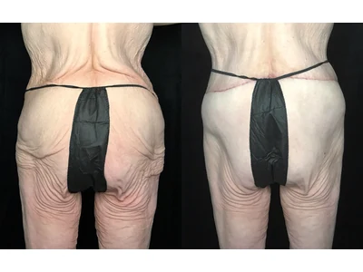 Before and after lower body lift, patient case 20024, view 5