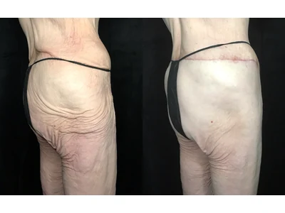 Before and after lower body lift, patient case 20024, view 6