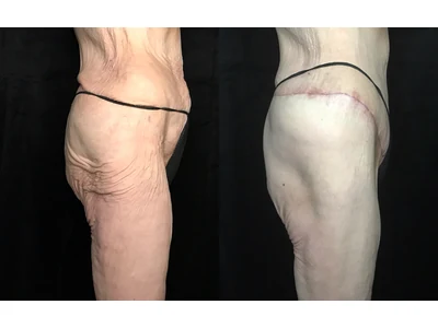 Before and after lower body lift, patient case 20024, view 7
