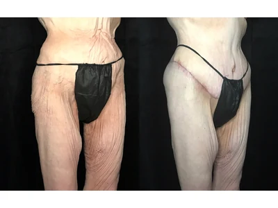 Before and after lower body lift, patient case 20024, view 8