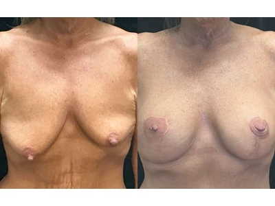 Before and after breast lift, patient case 20025, view 1