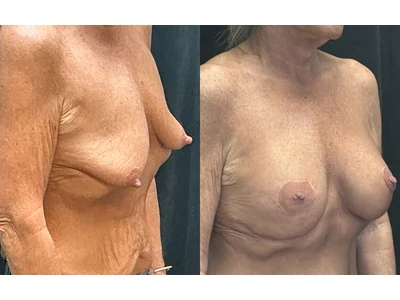 Before and after breast lift, patient case 20025, view 2
