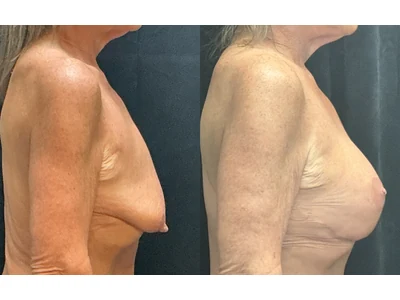 Before and after breast lift, patient case 20025, view 3