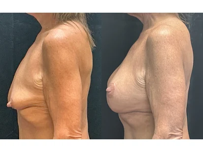 Before and after breast lift, patient case 20025, view 4