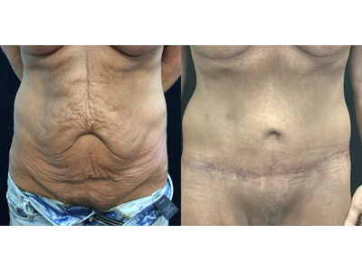 Before and after lower body lift, patient case 20026, view 1