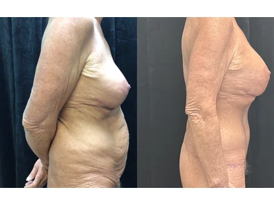 Before and after lower body lift, patient case 20026, view 2
