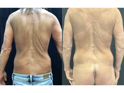 Before and after lower body lift, patient case 20026, view 3