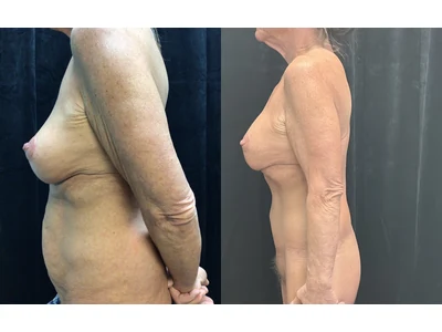Before and after lower body lift, patient case 20026, view 4