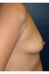 Saline Breast Implants from 34AA to 34C - Conkright Aesthetics