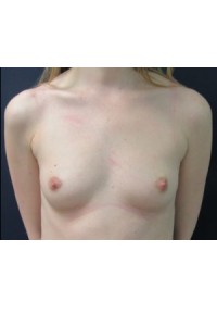 Breast Surgery Before & After Gallery